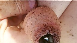 Startling Discovery: Maggots Are Eating My Penis!